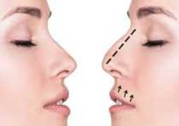 Ринопластика — коррекция носа