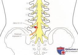 Специальные тесты пояснично-крестцового отдела позвоночника Рисунок 1. Задне-наружное выпячивание диска L4— L5 может вызвать…