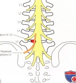 Специальные тесты пояснично-крестцового отдела позвоночника Рисунок 1. Задне-наружное выпячивание диска L4— L5 может вызвать…