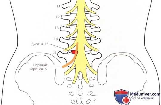 Специальные тесты пояснично-крестцового отдела позвоночника Рисунок 1. Задне-наружное выпячивание диска L4— L5 может вызвать…